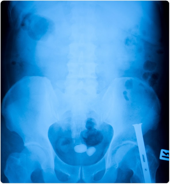 X-ray film of two stone in the bladder
